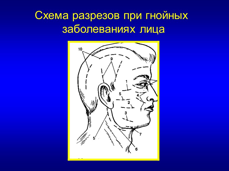 Схема разрезов при гнойных  заболеваниях лица